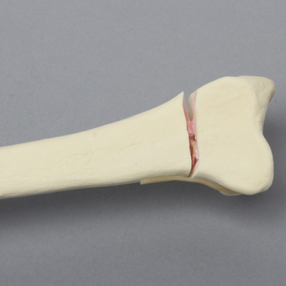 Radius with Transverse Fracture, Foam Cortical