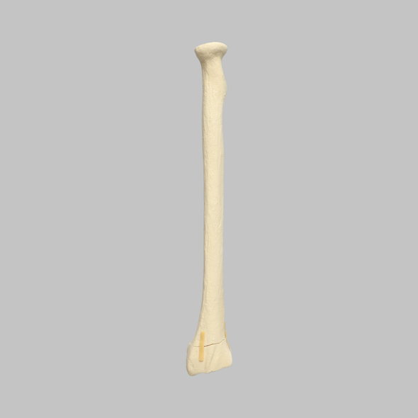 Radius with Transverse Fracture, Foam Cortical