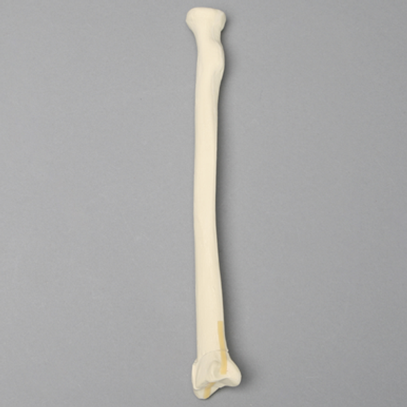 Radius with "Y" Fracture, Foam Cortical