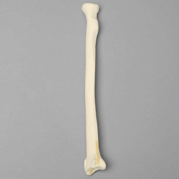 Radius with "Y" Fracture, Foam Cortical