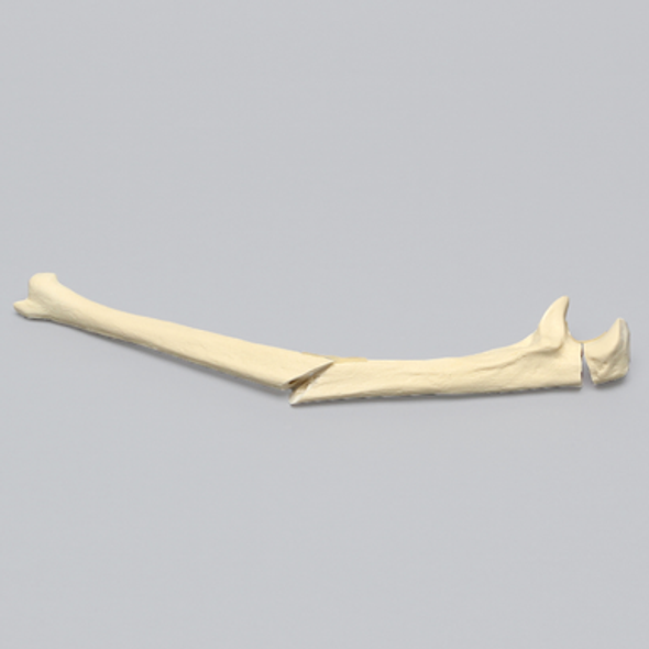Ulna with Oblique and Transverse Fractures, Foam Cortical