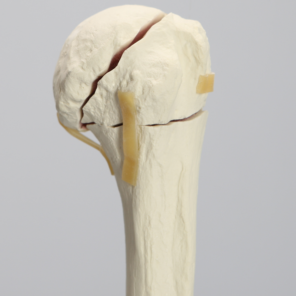 Elbow with Four-Part Fracture, Foam Cortical