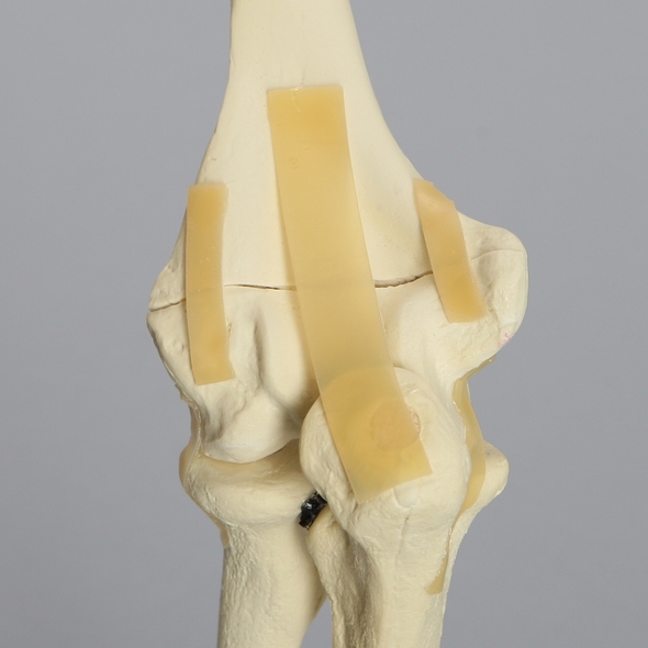 Elbow with Transverse Fracture, Foam Cortical