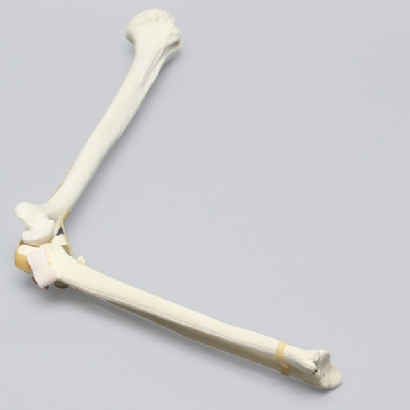 Elbow with Radial Head and Coronid Fractures and Severed Ligament, Foam Cortical