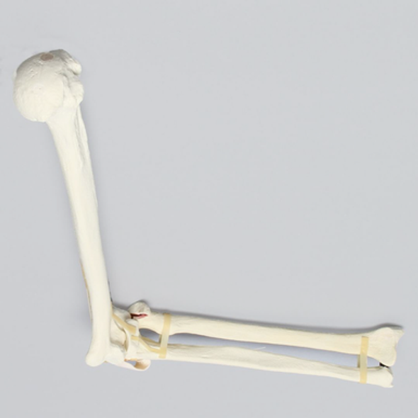 Elbow with Radial Head and Coronid Fractures and Severed Ligament, Foam Cortical