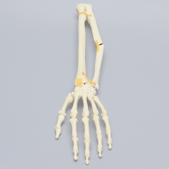 Hand and Wrist with Oblique and Colles' Fractures, Solid Foam
