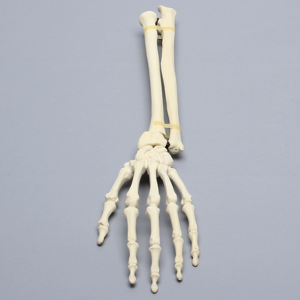 Hand and Wrist with Colles' Fracture, Solid Foam