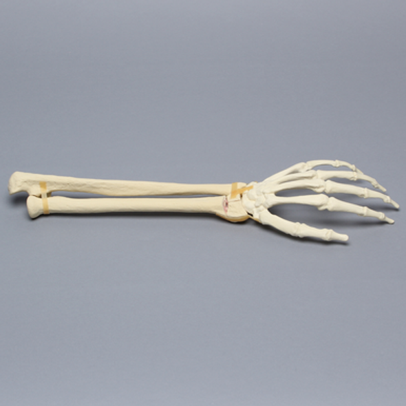 Hand and Wrist with Transverse Radial Fracture, Solid Foam