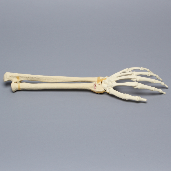 Hand and Wrist with Transverse Radial Fracture, Solid Foam