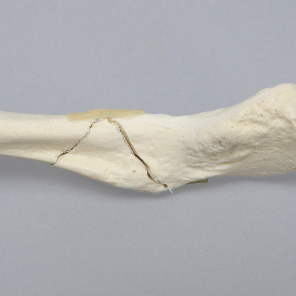 Clavicle with Butterfly Fracture, Solid Foam