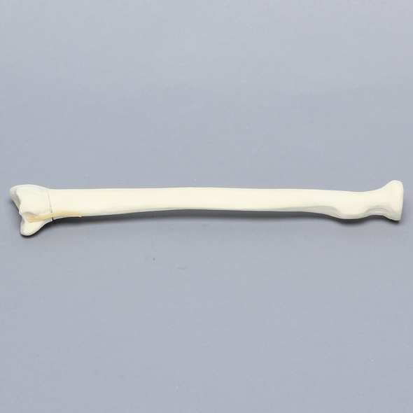 Radius with Transverse Colles' Fracture and Removed Tubercle, Foam Cortical