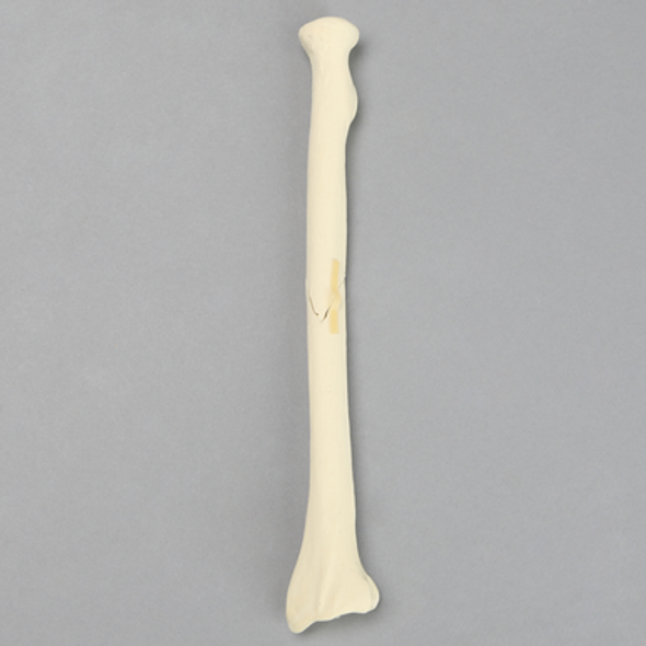 Radius with Oblique Fracture, Solid Foam