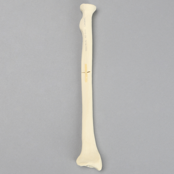 Radius with Oblique Fracture, Solid Foam