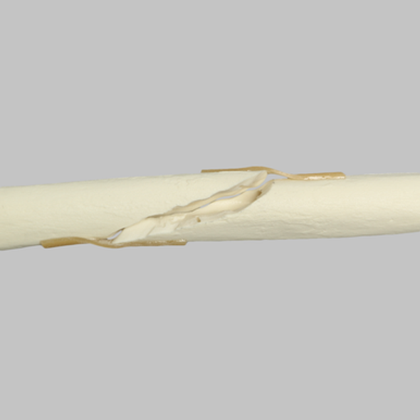Radius with Long Oblique Fracture, 5.5mm Canal, Solid Foam