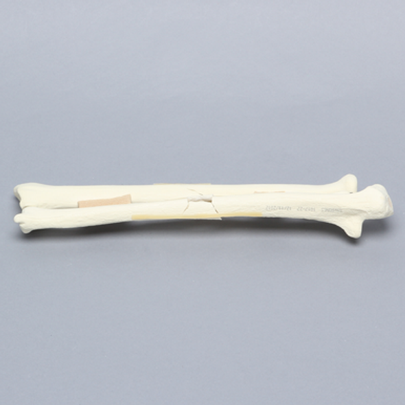 Ulna and Radius with Four-Part and Oblique Fractures, Solid Foam