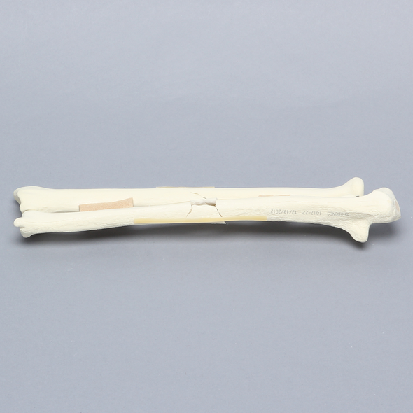 Ulna and Radius with Four-Part and Oblique Fractures, Solid Foam