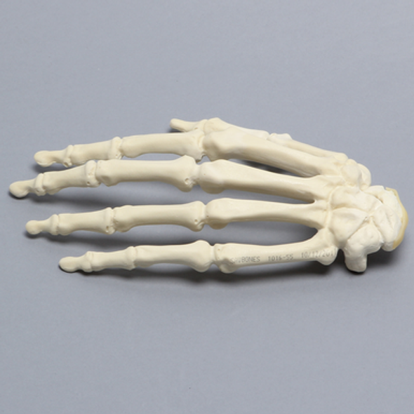 Hand with Scaphoid Fracture, Solid Foam