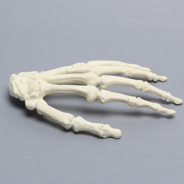 Hand, Multiple Finger Fractures, Solid Foam