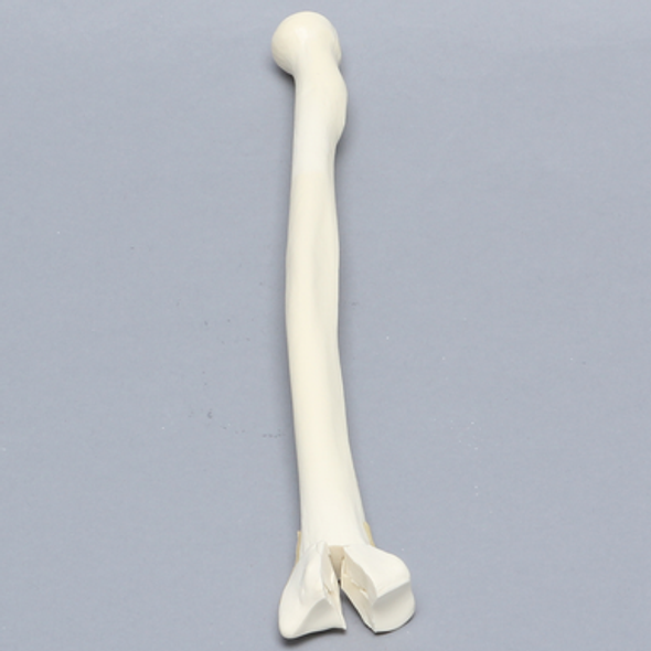 Radius, Three-Part Intra-Articular Fracture, Solid Foam