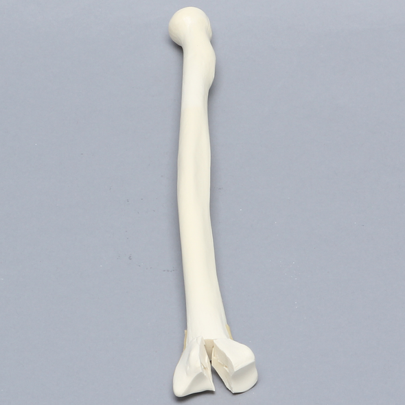Radius, Three-Part Intra-Articular Fracture, Solid Foam