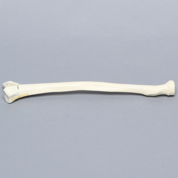 Radius, Three-Part Intra-Articular Fracture, Solid Foam
