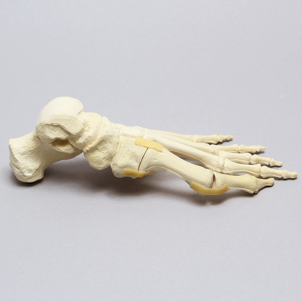 Foot with Valgus Deformity