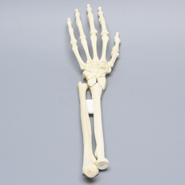 Hand and Wrist with Four-Part Fracture with Displacement, Foam Cortical