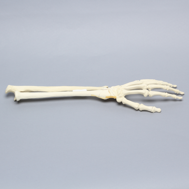 Hand and Wrist with Four-Part Fracture with Displacement, Foam Cortical