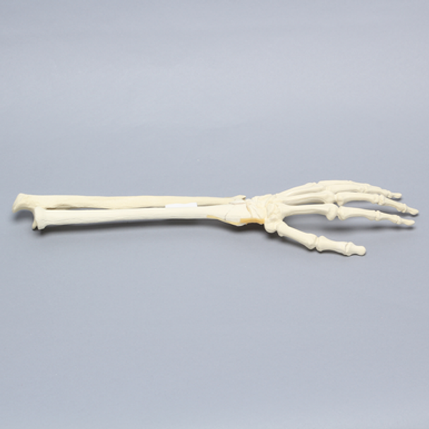 Hand and Wrist with Four-Part Fracture with Displacement, Foam Cortical