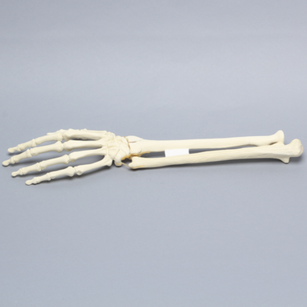 Hand and Wrist with Four-Part Fracture with Displacement, Foam Cortical