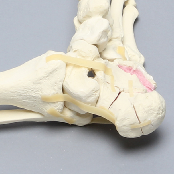 Foot and Ankle with Calcaneal and Talus Fracture