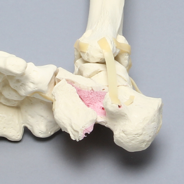 Foot and Ankle with Calcaneal and Talus Fracture