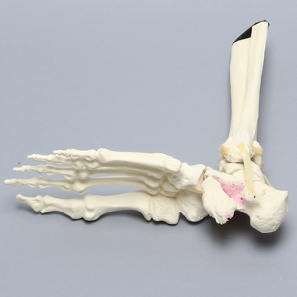 Foot and Ankle with Calcaneal and Talus Fracture