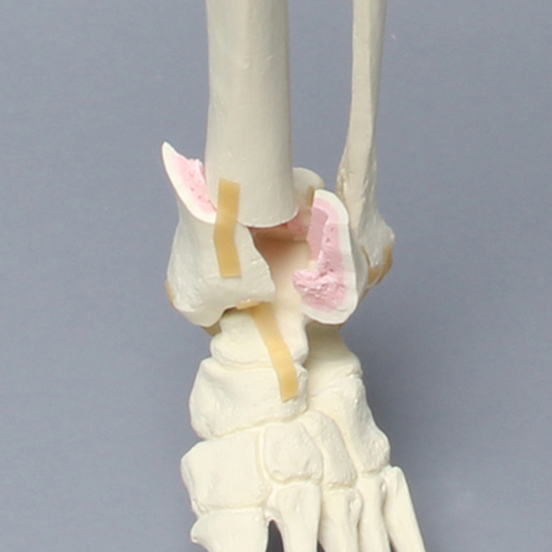Foot and Ankle with Four-Part Tibial Pilon Fracture
