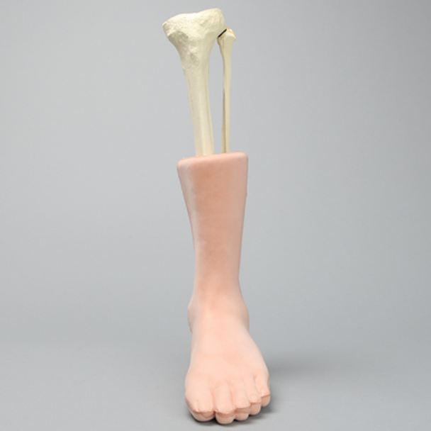 Foot and Ankle with Talar Neck and Six-Part Calcaneal Fracture, Encased