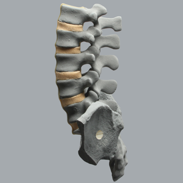 Spine, Lumbar, Bilateral Iliac Crests, Radiopaque