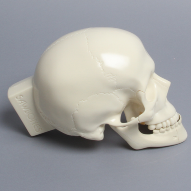 Skull, Full, With Le Fort I, Orbital, Zygomatic, and Mandibular Fractures