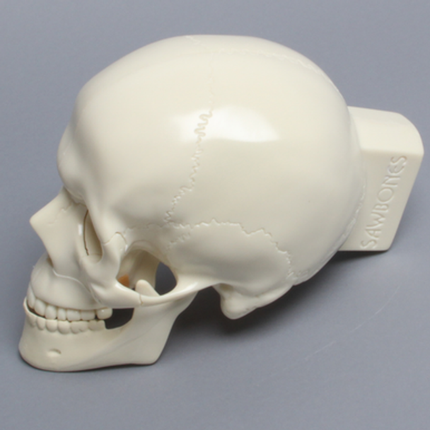 Skull, Full, With Le Fort I, Orbital, Zygomatic, and Mandibular Fractures