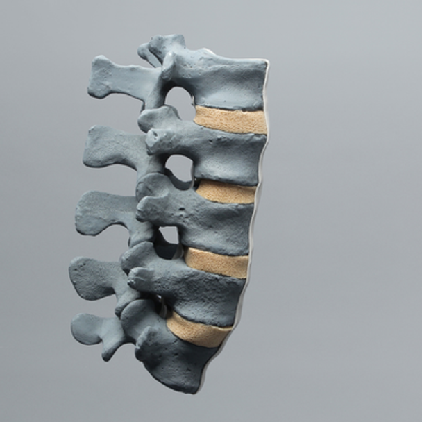 Spine, Lumbar Vertebrae, L1-L5, Radiopaque