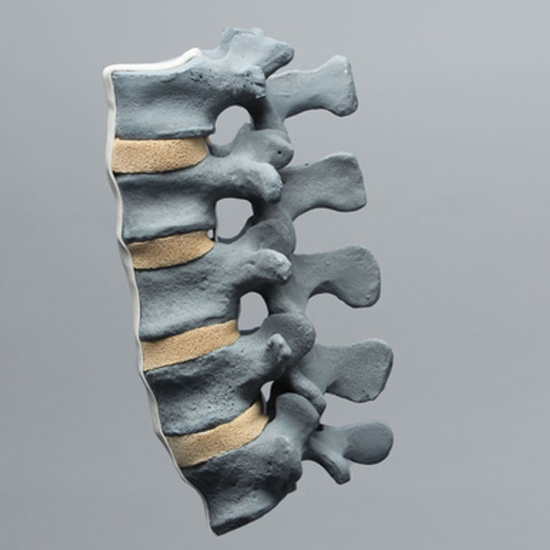 Spine, Lumbar Vertebrae, L1-L5, Radiopaque