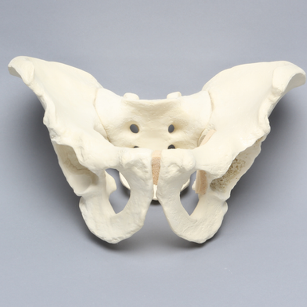 Pelvis with Global and Rim Defects, Full Male, Foam Cortical