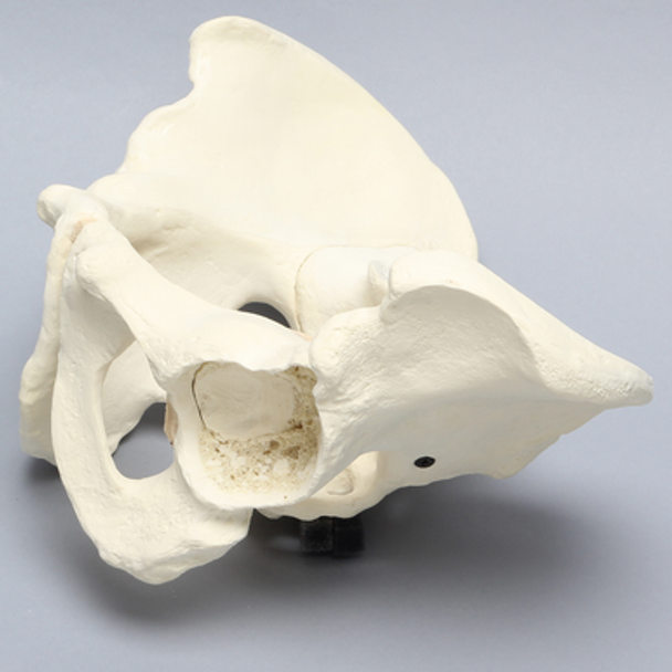 Pelvis with Global and Rim Defects, Full Male, Foam Cortical