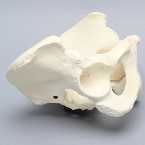 Pelvis with Global and Rim Defects, Full Male, Foam Cortical