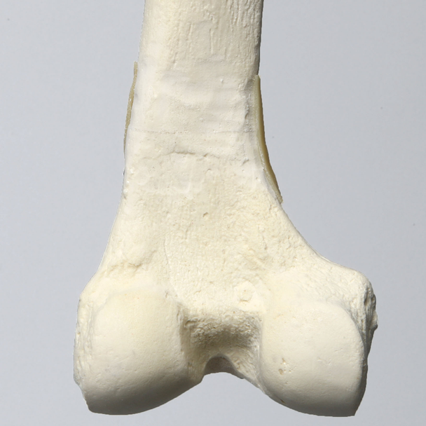 Femur with 10 Degree Varus Deformity