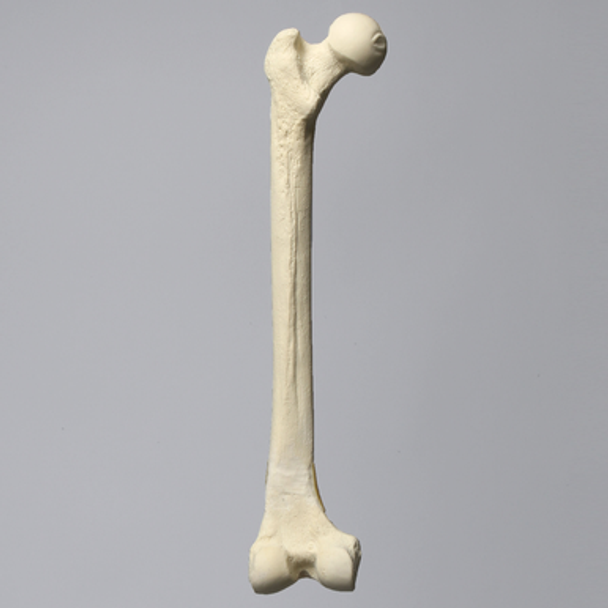 Femur with 10 Degree Varus Deformity