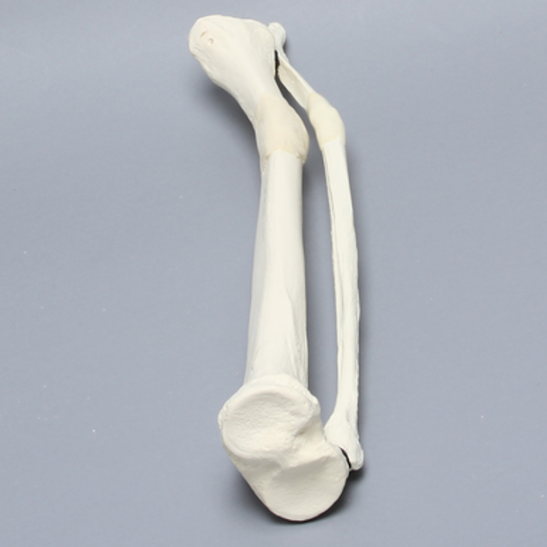 Tibia and Fibula with Malunions, Varus, and Rotation