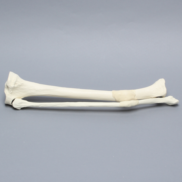 Tibia and Fibula with Malunions, Varus, and Rotation