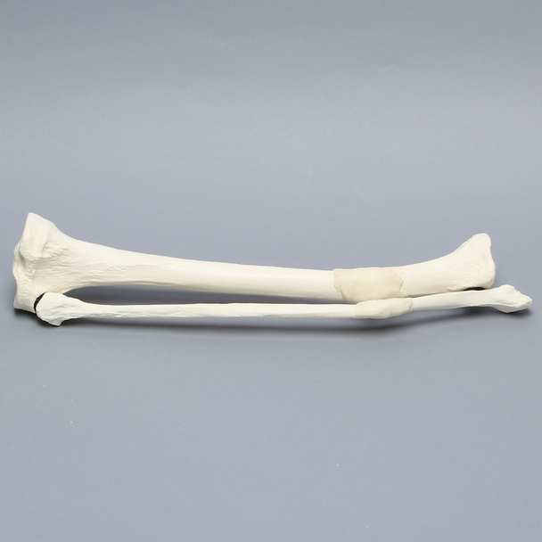 Tibia and Fibula with Malunions, Varus, and Rotation