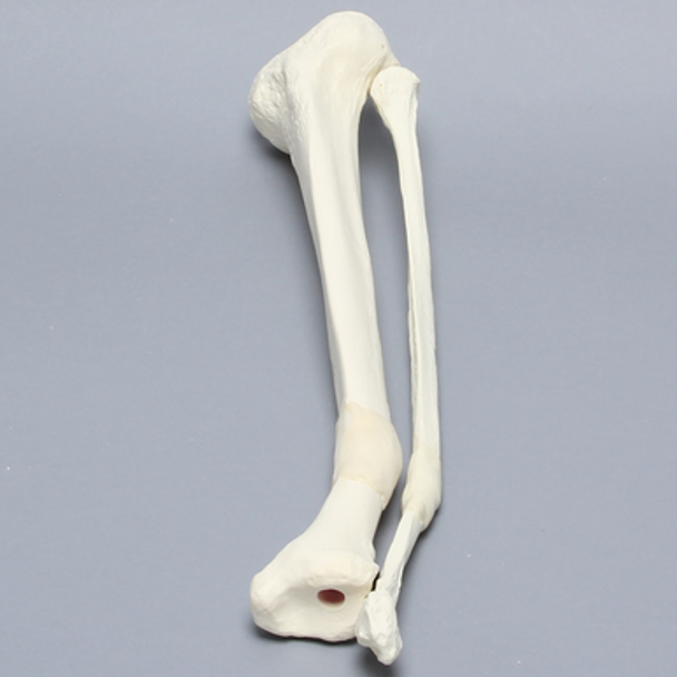 Tibia and Fibula with Malunions, Varus, and Rotation