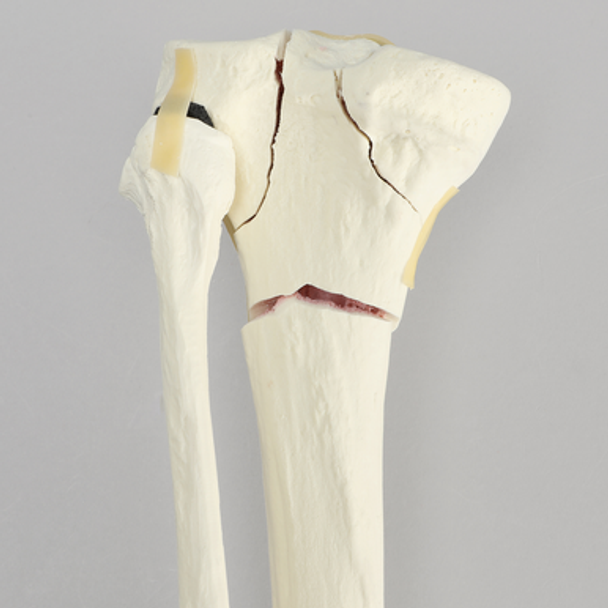 Tibia with Bicondylar and Transverse Fractures and Intact Fibula